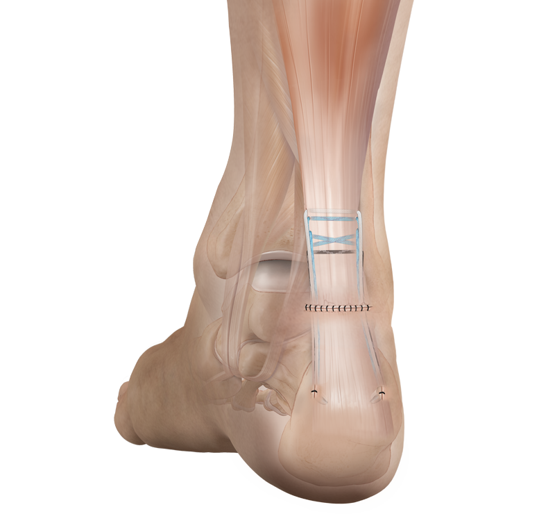 Arthrex - Implant System, Achilles Midsubstance SpeedBridge